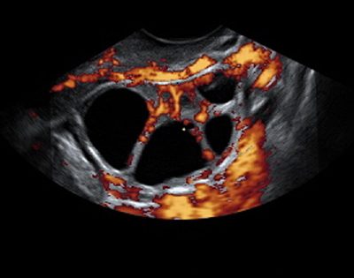 Niedrige ovarielle Reserve; Welches ist die zuverlässigste Technik für ihre Diagnose?