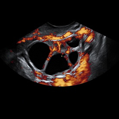 Bassa riserva ovarica: tecnica più affidabile per diagnosticarla