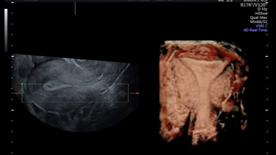 Do abnormal uterine contractions cause embryo implantation failure?