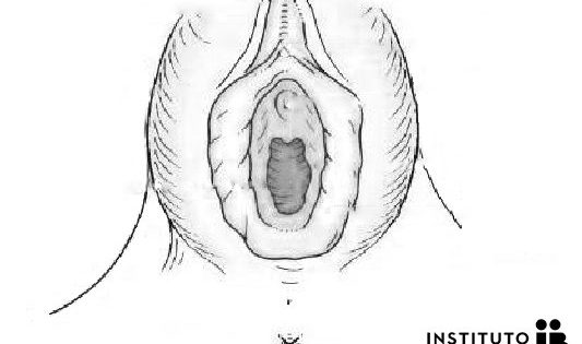 Hipertrofia genital: Cirugía de labios vaginales