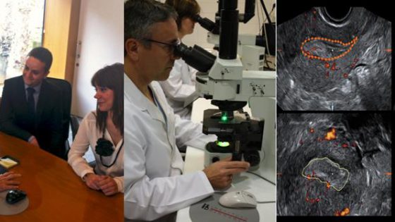 Usefulness of Comprehensive Chromosomal Screening (PGS/PGT-A/CCS) in Recurrent Miscarriages