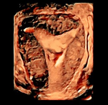 Endometriose, warum wird sie von unserem Immunsystem geduldet?