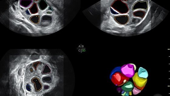 ¿Qué es la Reserva Ovárica? ¿Qué importancia tiene en la fertilidad?