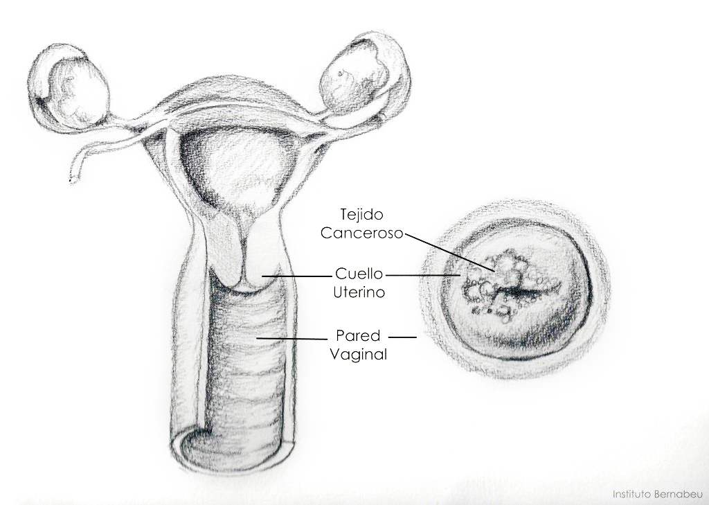 Virus del papiloma humano y Cáncer de Útero en Instituto Bernabeu