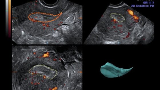 Awarded with the national prize of the SEGO ultrasound section for the best “gynaecology ultrasound” project.