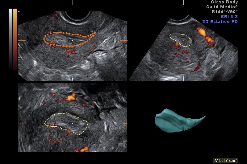 Awarded with the national prize of the SEGO ultrasound section for the best “gynaecology ultrasound” project.