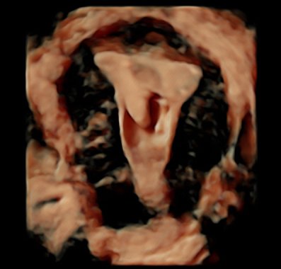 Ultrasound scan evaluation for the tubes permeability: Hysterosonography