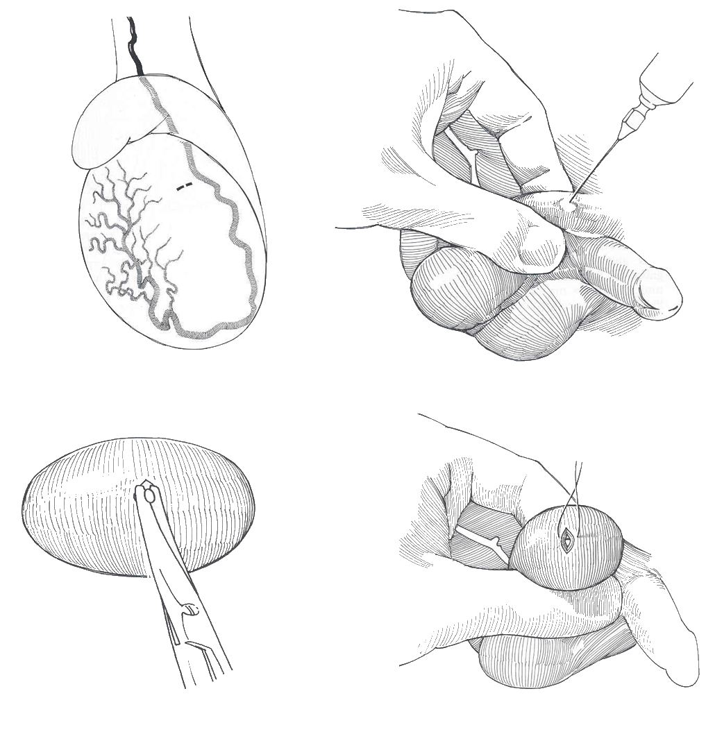 Treatment Of Klinefelter´s Syndrome And Fertility