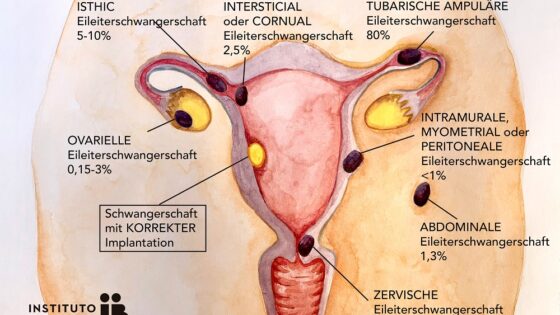 Die ektopische Schwangerschaft