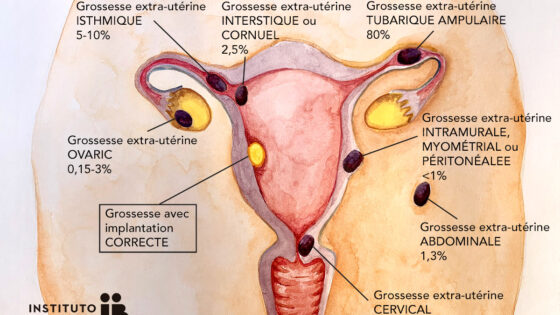 Grossesse Extra-uterine