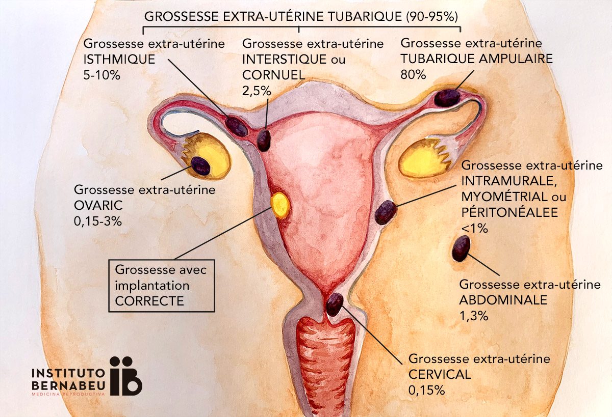 Grossesse Extra-uterine