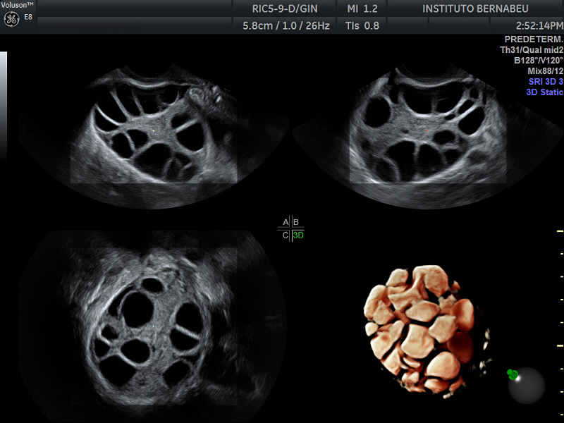 Behandlung des ovariellen Hyperstimulationssyndroms - Instituto Bernabeu