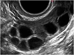 Accumulation of oocytes in patients with a low response - Instituto Bernabeu