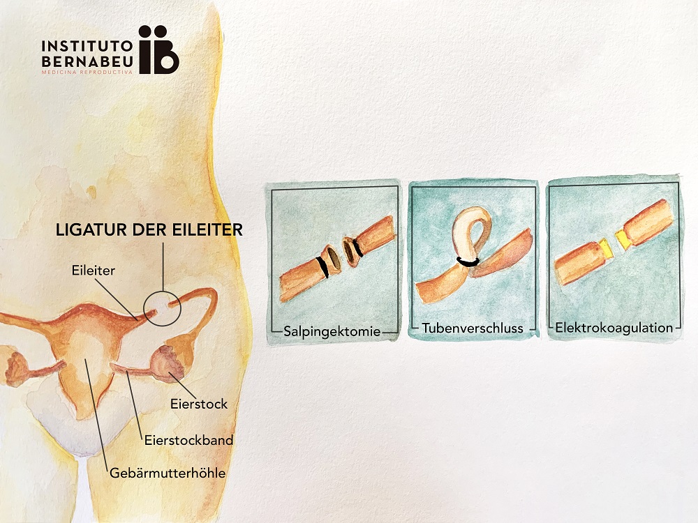 Ist es möglich, nach einer Eileiterdurchtrennung Mutter zu werden? - Instituto Bernabeu