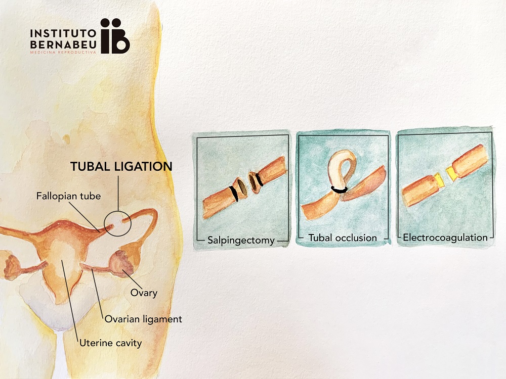 Is it possible to become a mother after tubal ligation? - Instituto Bernabeu