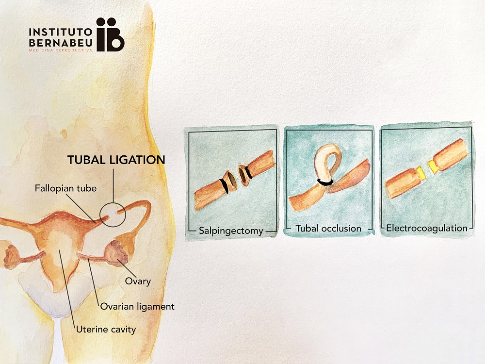 The value of hysterosalpingography before reversal of sterilization  procedures involving the fallopian tubes