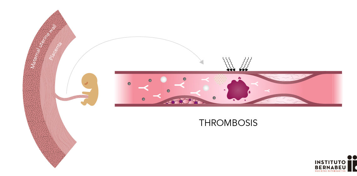 Syndrome des antiphospholipides: qu’est-ce que c’est? Comment cela affecte-t-il la réussite de la grossesse?