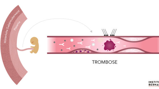 Antiphospholipid-Syndrom: Was ist das? Wie beeinträchtigt es die Schwangerschaft?