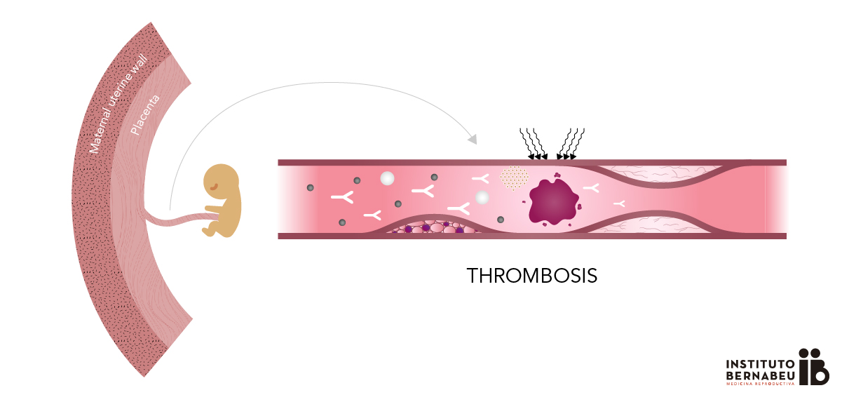 Antiphospholipid Syndrome: What is it? How does it affect pregnancy? Instituto Bernabeu
