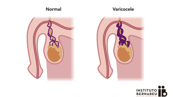 Varicocele e Infertilidad