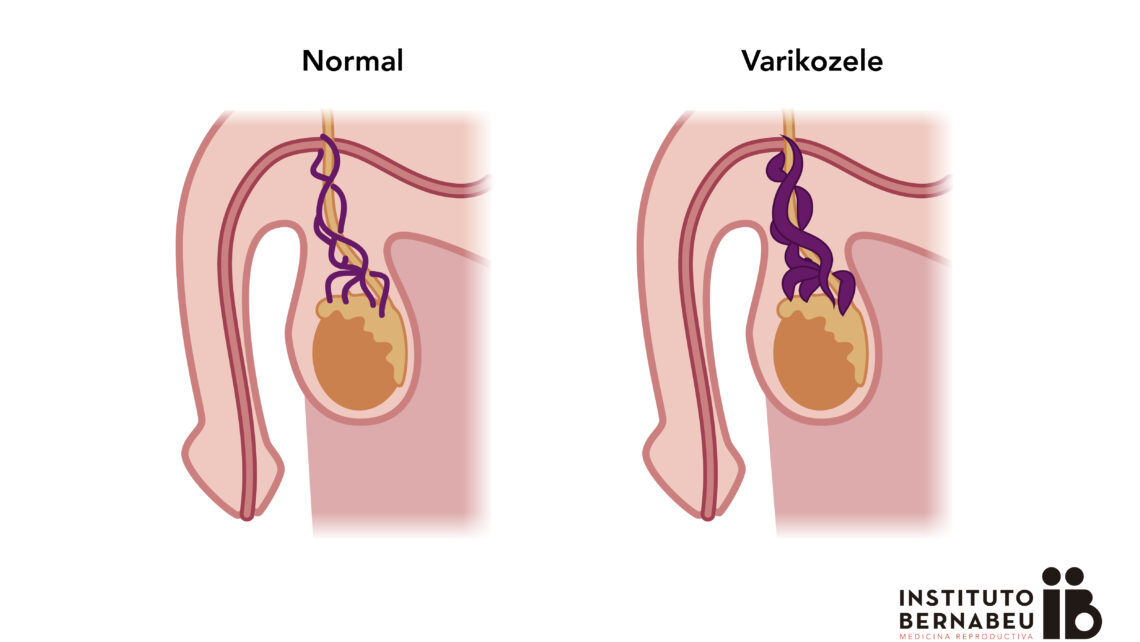 prostatitis unfruchtbarkeit