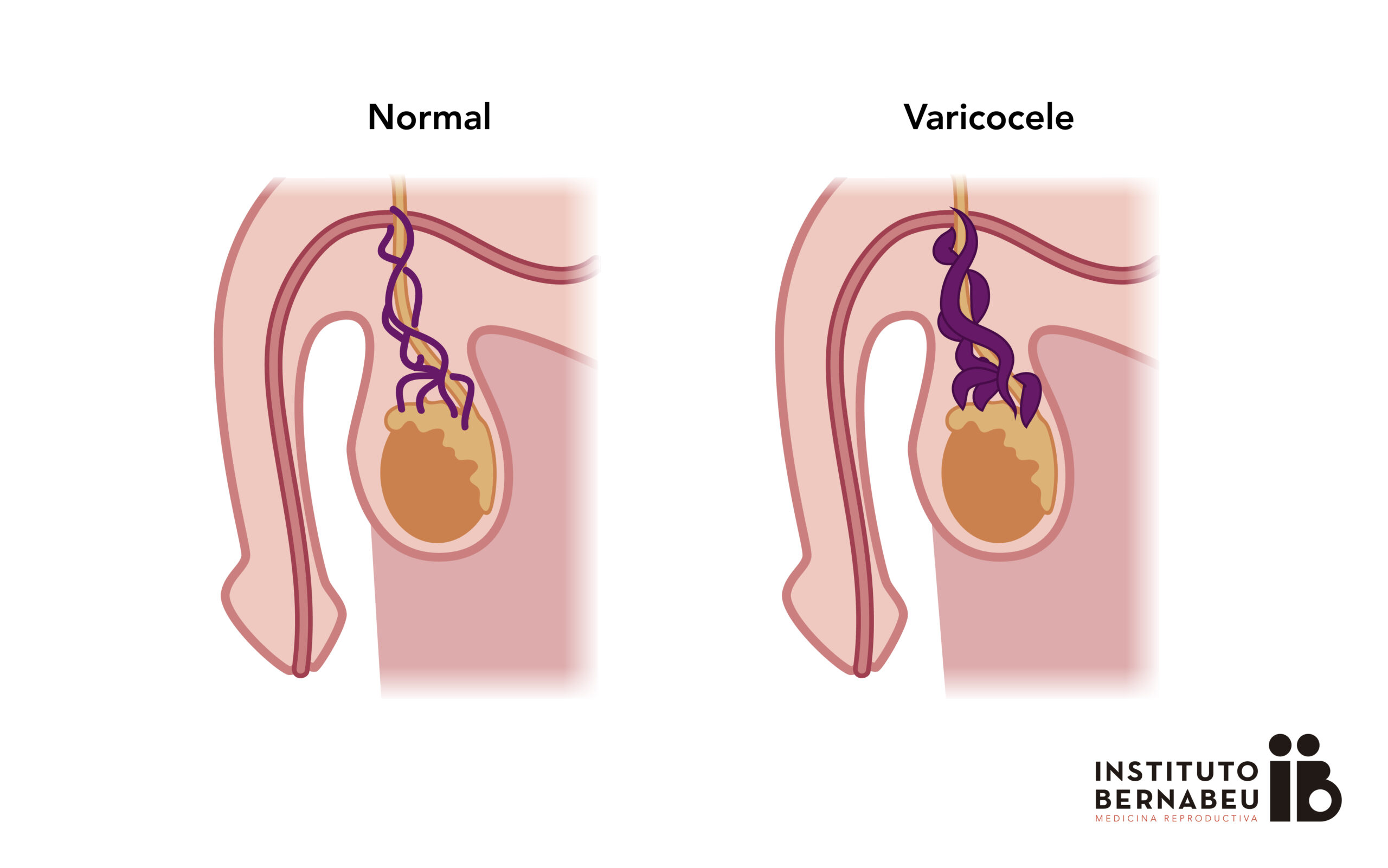 Prostatitis és varicocel