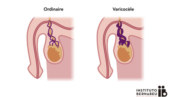 Varicocèle et infertilité