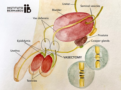 How to be a parent after vasectomy? - Instituto Bernabeu