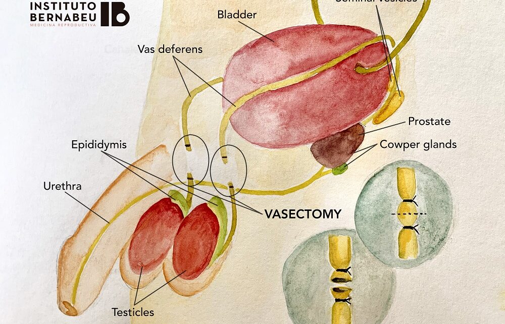 Vasectomies: the male contraceptive