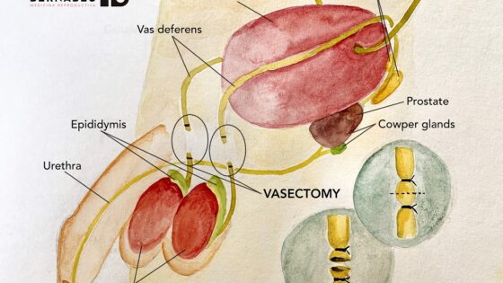 Vasectomies: the male contraceptive