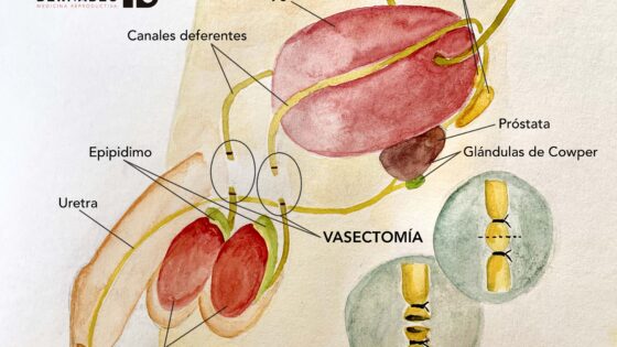 La vasectomía, el anticonceptivo masculino