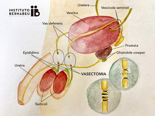 Come possiamo essere genitori dopo una vasectomia? - Instituto Bernabeu