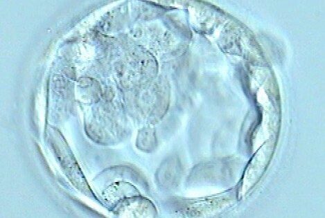 Transfert de l’embryon le 3ème ou 5ème jour. Avantages et inconvénients