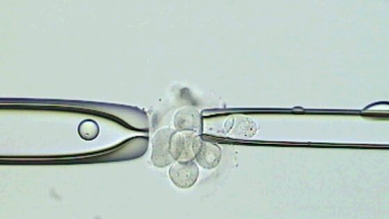 EL INSTITUTO BERNABEU DONARÁ TRATAMIENTOS DE DIAGNÓSTICO PRENATAL A LOS AFECTADOS DEL SÍNDROME DE MARFAN