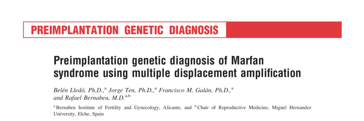 Preimplantation genetic diagnosis of Marfan syndrome using multiple displacement amplification