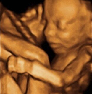 The importance of accurate 3D and 4D ultrasound scans