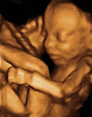 The importance of accurate 3D and 4D ultrasound scans