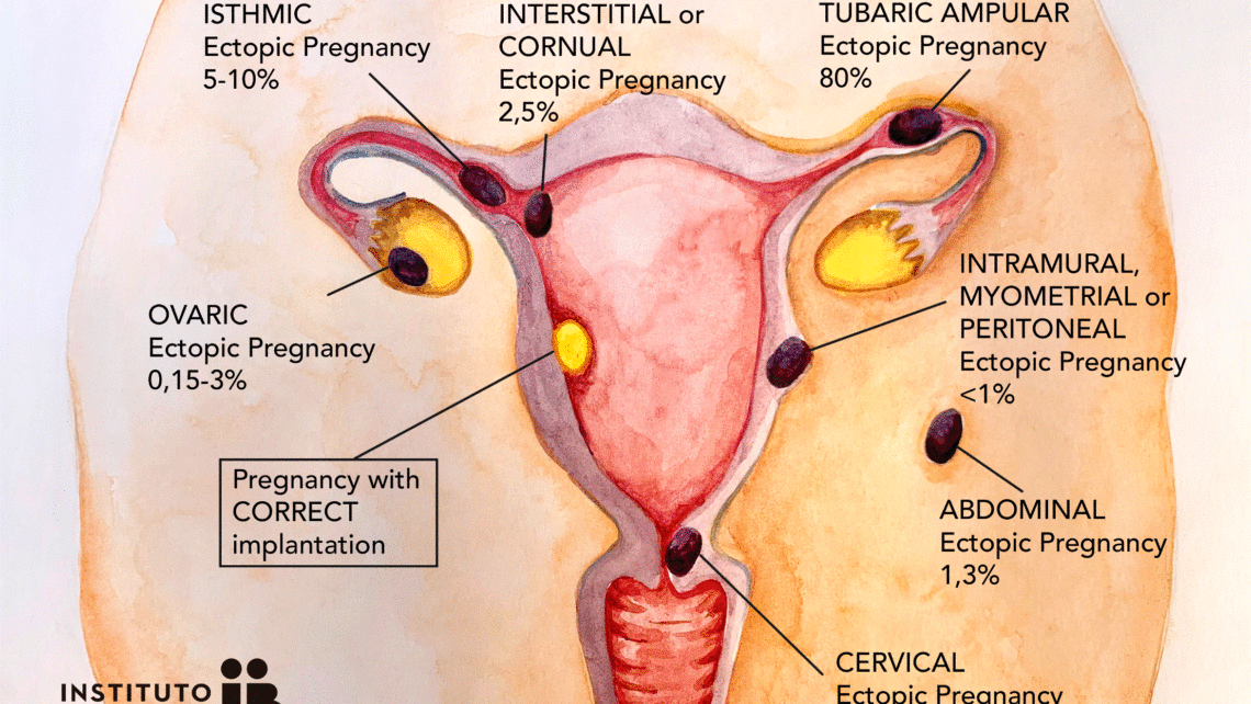 Ectopic pregnancy
