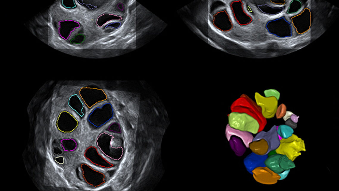 Ovarielle Stimulation in der Lutealphase