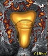 Forschung über das Endometrium. Kann dessen Vaskularisation das Ergebnis der Eizellspende beeinflussen?