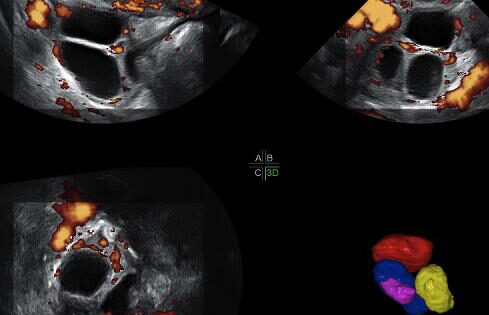 3D-Steuerung der Vaskularisation von Follikeln bei Patientinnen mit schwachem Ansprechen der Eierstöcke.