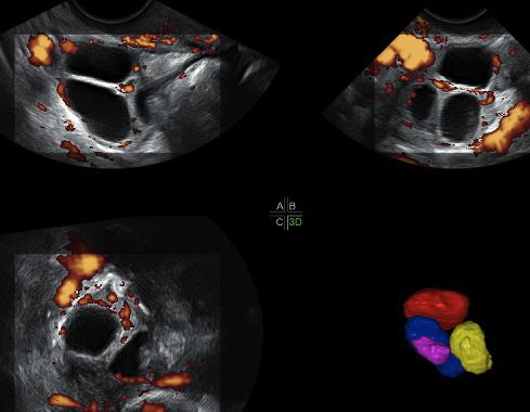 3D-Steuerung der Vaskularisation von Follikeln bei Patientinnen mit schwachem Ansprechen der Eierstöcke.