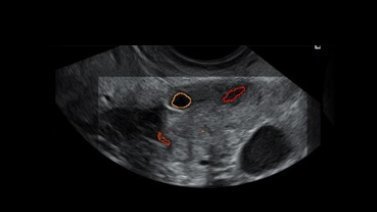 Early Follicular Phase vs Lutheal Phase Ovarian Stimulation in Bologna Criteria IVF/ICSI Cycles (LUTEAL Trial) (LUTEAL) NCT02625532