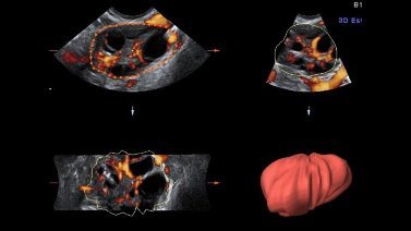 Conventional Ovarian Stimulation vs. Single Injection Stimulation of Corifollitropin Alfa in Oocyte Donor (TAIL) NCT03939403