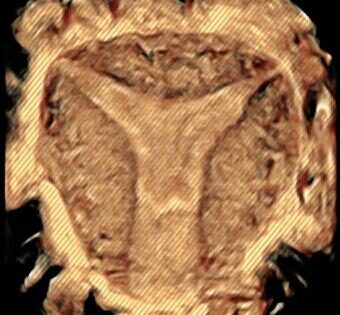 Ricerca IB: Nuova classificazione di Adenomiosi