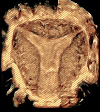 Instituto Bernabeu Research: New classification of Adenomyosis