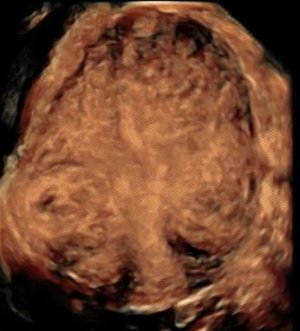 Progress with a view to avoiding implantation failure: research on uterine contractions. IB research presented at the ESHRE 2016 European Fertility Congress