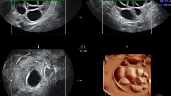 Traitement avec l’hormone de croissance (GH) pour une faible réponse ovarienne