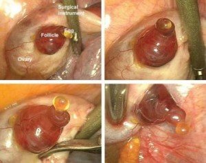 L’ovulation - Instituto Bernabeu