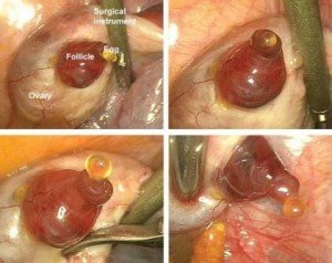 Ovulation - Instituto Bernabeu